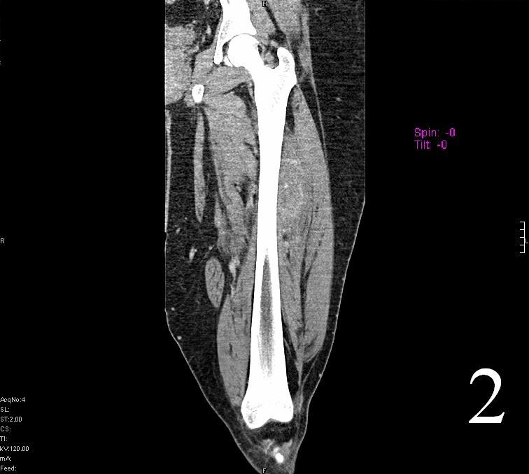 Tumor Surgery : Bone Cancer Tumors : Sarcoma Surgeon : NYC